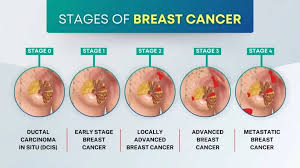 Image result for Breast Cancer Staging