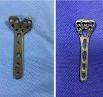 Fixed-angle and variableangle locking plates used in the ...
