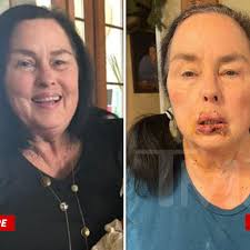 Duck Dynasty' Star Kay Robertson's Brutal Dog Bite Injuries