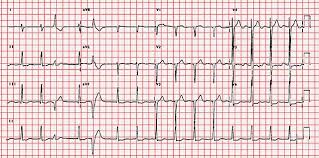 The language of the heart. How To Interpret An Ecg In Seven Steps Online Medical Library