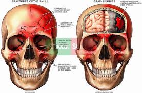 Comminuted Skull Fracture Anatomy Picture Reference And Health News Brain Surgery Brain Injury Traumatic Brain Injury