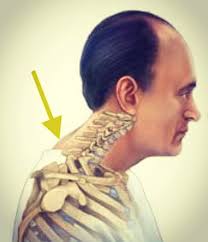 A neck hump is also known as a buffalo hump or a dowager's hump. Chiropractor For Neck Hump Macquarie Chiro Chiropractor Golden Bay Secret Harbour Mandurah