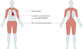 Image result for Myopathy