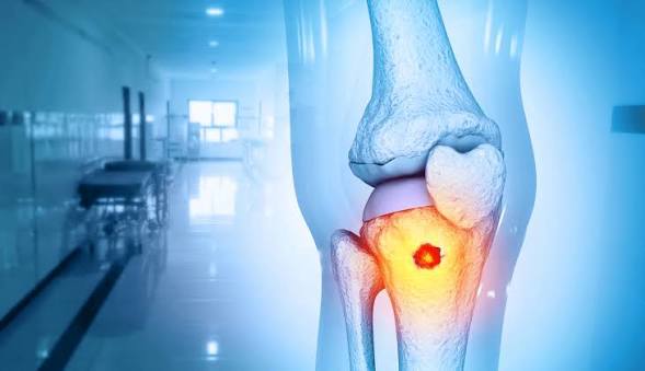 Bone Cancer vs Bone Marrow Cancer| HCG