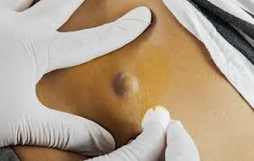 While ingrown hairs more commonly occur in individuals with curly hair, almost everybody will develop one at some. I Had A Benign Cyst Removed Here S What That S Like Men S Health
