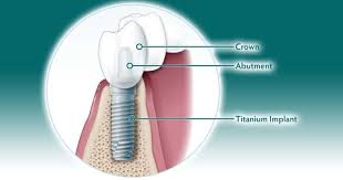 Image result for dental implant