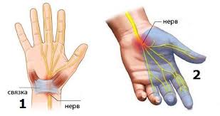 Tunnelnyj Sindrom U Ajtishnikov Kogda Ruki Otvalivayutsya Dev By