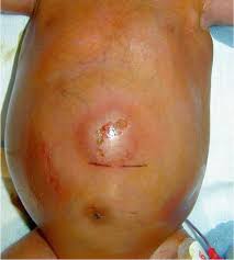 Image result for Necrotizing Enterocolitis