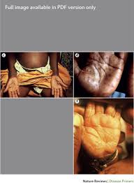 Syphilis | Nature Reviews Disease Primers