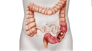 The colon is the final part of the digestive tract. Colon And Rectal Cancer Can Go Missed In Younger Adults Study Shows Cnn
