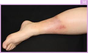 Image result for Lipodermatosclerosis