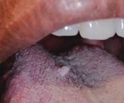 Image result for papillomavirus tongue)