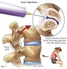 Pin On Back Neck Saga Living With Chronic Pain