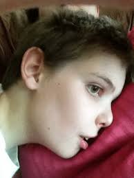 Photographs of the patient showing epicanthal folds, downslanting...