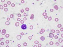 Tests like a blood smear, white blood cell differential, and reticulocyte count can often help assess anemia after an abnormal cbc. Anemia Wikipedia