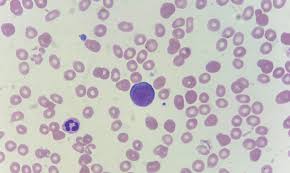 Image result for Peripheral Smear