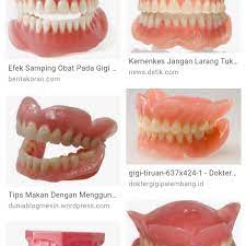 Mungkin anda mengira bahwa gigi palsu hanya digunakan oleh lansia, padahal pada usia berapapun disarankan untuk menggunakan gigi palsu jika. Pasang Gigi Palsu Minat Wa 085733773836 Home Facebook
