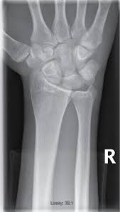 Image result for Hamate Bone