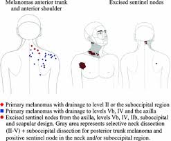 Shotty left cervical lymph nodes have been additionally present. Lymphatic Drainage Patterns From Melanomas On The Shoulder Or Upper Trunk To Cervical Lymph Nodes And Implications For The Extent Of Neck Dissection Springerlink
