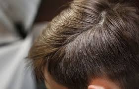 Perlakukan kulit kepala kamu dengan ramuan alami ini setiap minggu untuk merawat kulit kepala yang mayones menjadi favorit untuk mengobati masalah kulit kepala yang kering dan terkelupas. 10 Penyebab Kulit Kepala Gatal Dan Cara Mengatasinya Halaman 7 Kompas Com