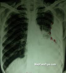 Loculated effusion) or underlying atelectasis. Pleural Effusion Causes And Treatment Medcaretips Com