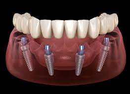 How Long Do All On 4 Implants Last Here S What You Need To Know