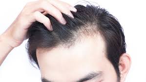 Any human being can suffer hair loss. Going Bald Too Young Ohio State Medical Center