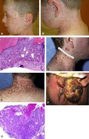 Learn more about common types of carcinoma, as well as carcinoma treatment and therapy options. Chronic Phototoxicity And Aggressive Squamous Cell Carcinoma Of The Skin In Children And Adults During Treatment With Voriconazole Journal Of The American Academy Of Dermatology