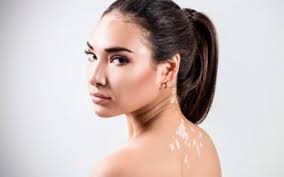 Cara, cuello, axilas, dorso de las manos, alrededor de los orificios naturales como la boca. Piel Seca Causas Sintomas Y Tratamientos