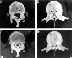 Despite this, pancreatic cancer is among the deadliest types of cancer, which is why it's extremely important to know and recogni. Epidural Compression Of The Cauda Equina Caused By Vertebral Osteoblastic Metastasis Of Prostatic Carcinoma Resolution By Hormonal Therapy Journal Of Neurology Neurosurgery Psychiatry