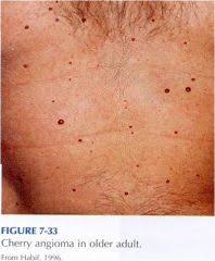When lesions are surrounded by a purpuric halo, amyloidosis should be suspected. Sp12 Interventions Flashcards Cram Com