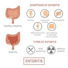 Eine analfissur kann auch zu blut im stuhl führen. Darmentzundung Enteritis Ursachen Symptome Behandlung Medlexi De