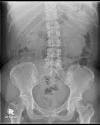Image result for Splenic Abscess