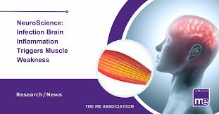 Image result for Muscle Weakness