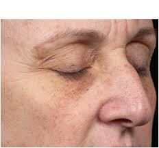 Our online store offers our patients the convenience of 24x7 online shopping for skincare products and aesthetic services, including dermaplaning, facials, . Clear Brilliant Preventative Skin Treatment