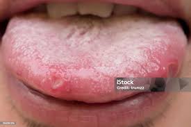 Image result for Puchýře na jazyku