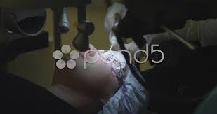 Laser Eye Surgery Step 4 Surgeon Rinsing An Eye Stock Footage Surgery Step Laser Eye Laser Eye Surgery Laser Eye Surgeon