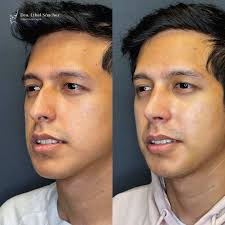 🙋🏻‍♀️ Cambios increíbles con una rinoplastia. Atrévete a conocer una  nueva versión de ti y realza tu belleza con una transformación que te hará  sentir mucho más seguro y feliz ✨ 👩🏻‍⚕️