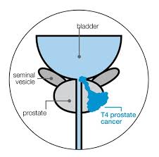 Find the information you need today. Just Diagnosed Prostate Cancer Uk
