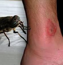 Image result for Fly Bite