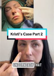 ✨ Kristi's Case Part 2: Treatment post dissolving ✨ In Part 1, we shared  the struggle of this beautiful patient from New York, who came to us with  chronic swelling and frustration after a series of ...