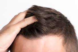 Androgenetic hair loss is inherited in an autosomal dominant manner, which means that the gene and this problematic genetic code may cause hair loss in men and women, so sons and daughters. 5 Myths About Hair Loss Debunked Elmens