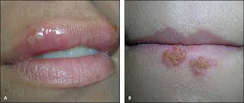 How can i stop cold sores from forming? Nongenital Herpes Simplex Virus American Family Physician