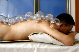 Cupping Æ‹”ç½ Chinese Language Blog