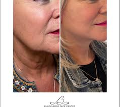 Blackledge Face Center