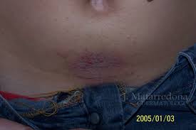 Image result for dermatitis contacta