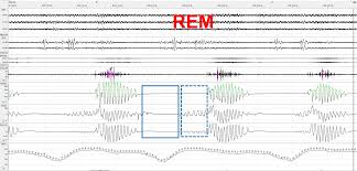 Image result for Cheyne-Stokes Respiration