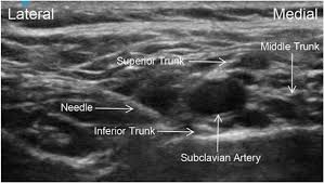 Image result for Superior Trunk Block