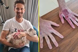 Dale coyne racing with rwr. Formula One Star Romain Grosjean Shows Off Gruesome Hand Injuries To Reveal Full Extent Of Bahrain Horror Crash