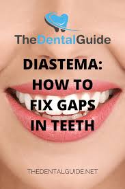 This gap teeth fix is not suitable for larger gaps, because bonding can make the teeth look too big. Diastema How To Fix Gaps In Teeth The Dental Guide Usa